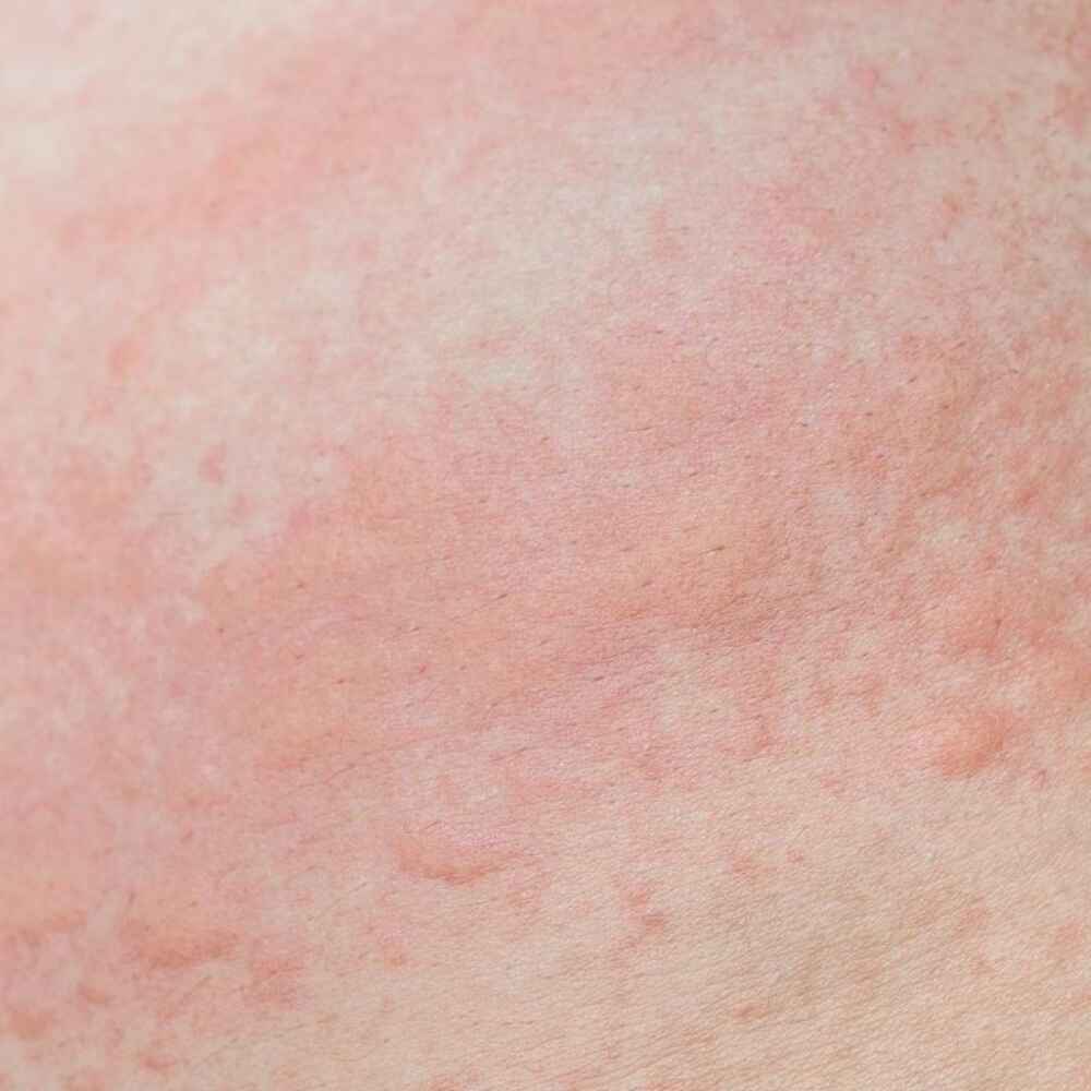 Close up of skin hives