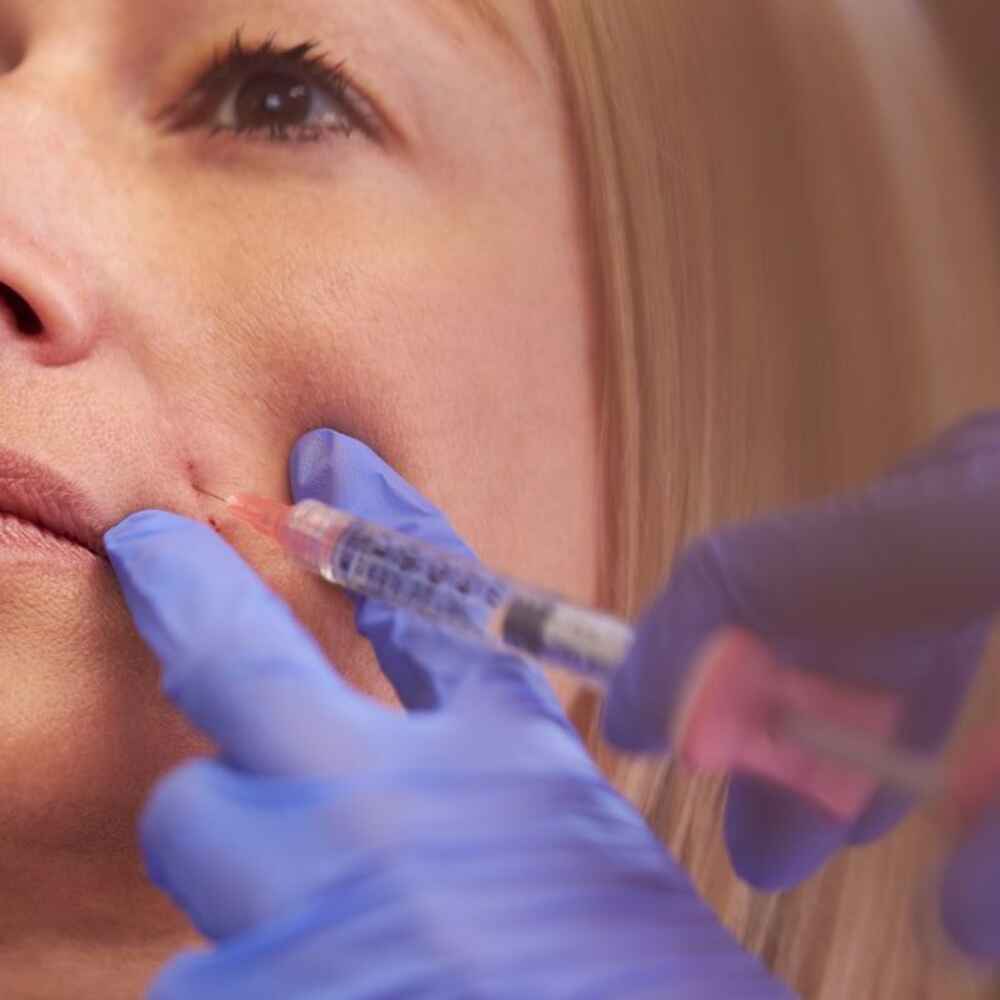 Facial plastic surgeon injecting Radiesse dermal filler into patient's face