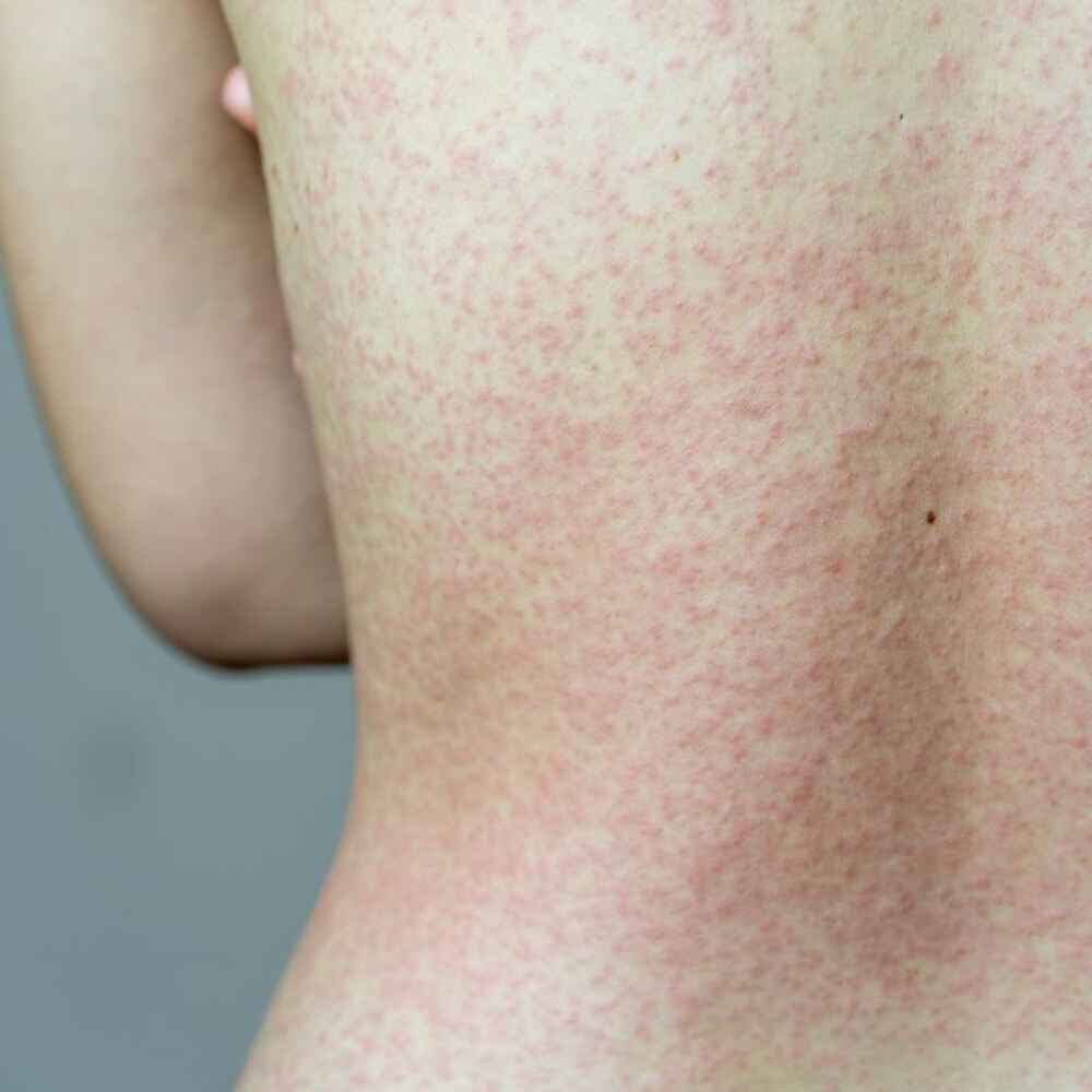 Woman with skin rash on her back