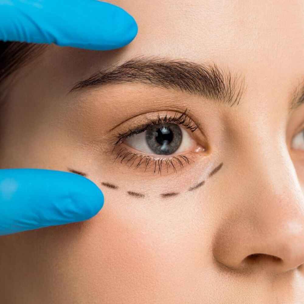 Woman preparing to get blepharoplasty eyelid surgery