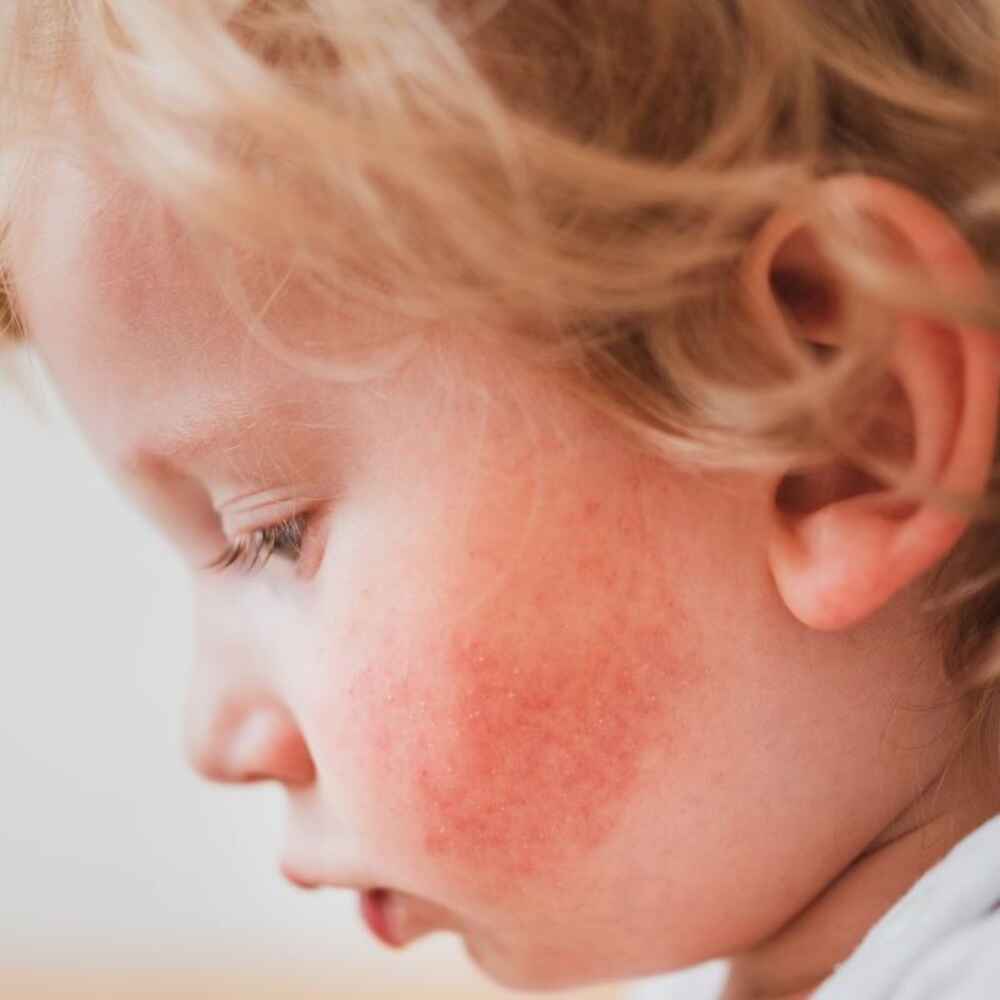 Child with pediatric allergies and skin reaction